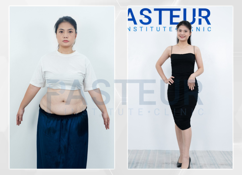 Trước và sau giảm béo của khách hàng tại phòng khám giảm béo Pasteur